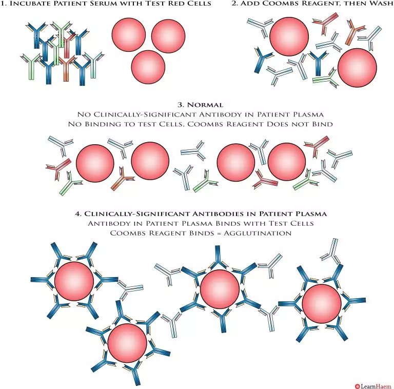 The Coombs Test LearnHaem Haematology Made Simple