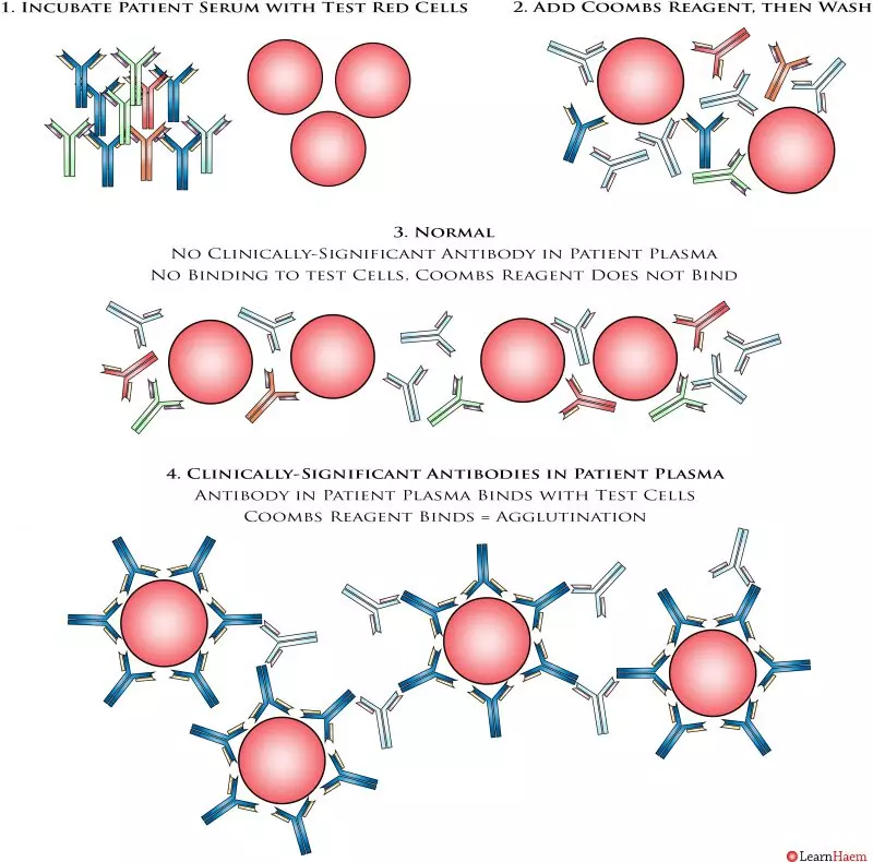 The Coombs Test LearnHaem Haematology Made Simple