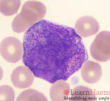 Acute Promyelocytic Leukaemia (APML)