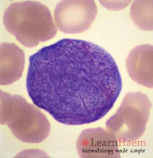 Acute Promyelocytic Leukaemia (APML)