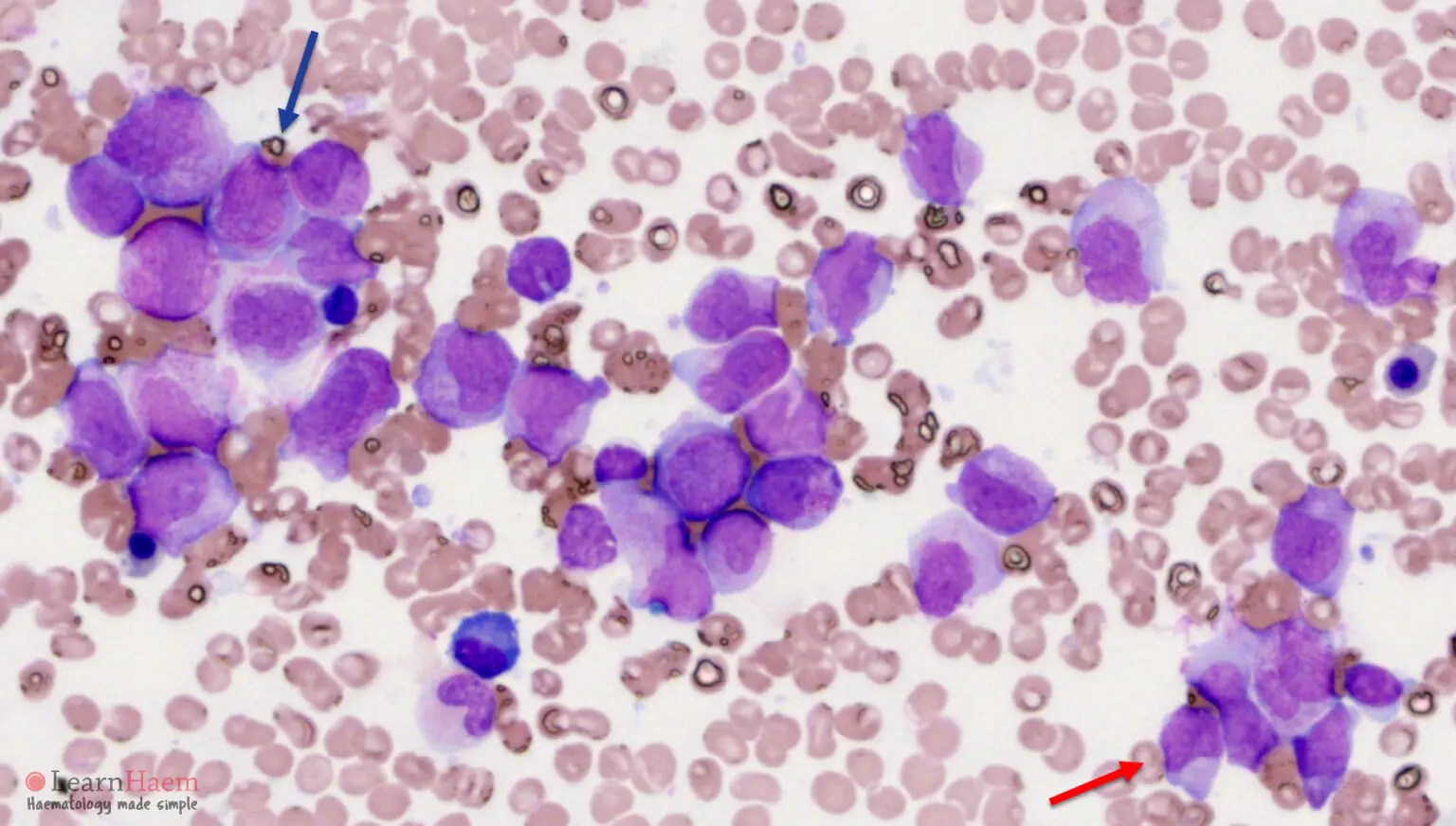 Acute Promyelocytic Leukaemia (APML) - LearnHaem | Haematology Made Simple