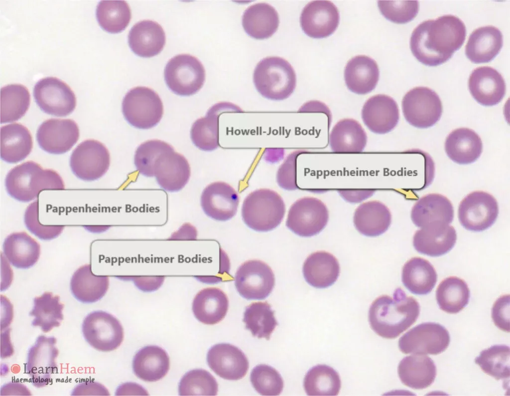 Howell-Jolly Bodies. Peripheral blood film from a patient who had a splenectomy showing a Howell-Jolly body in a red blood cell and surrounding cells with Pappenheimer bodies.