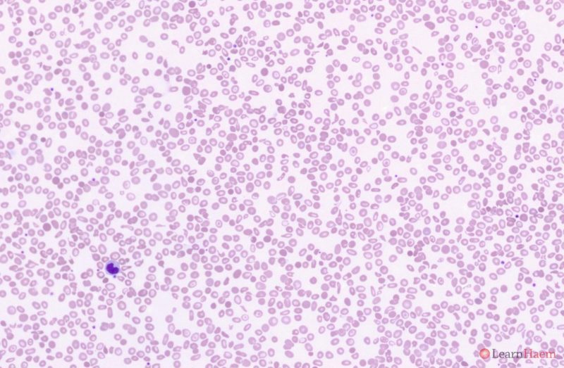 haemoglobin-h-constant-spring-disease-learnhaem-haematology-made-simple