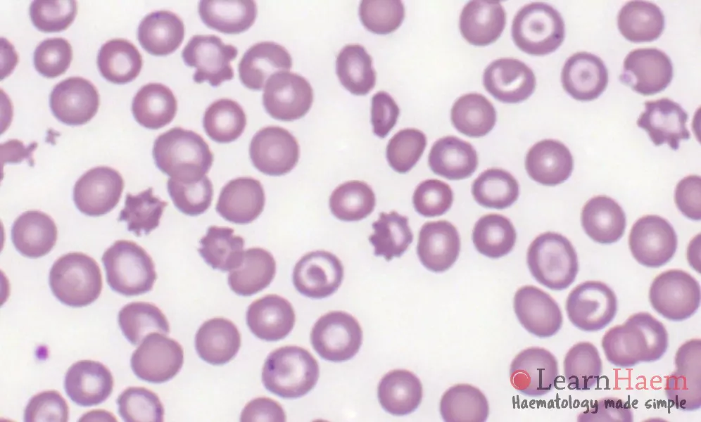 Acanthocytes. Peripheral blood film from a patient who had a splenectomy, showing circulating acanthocytes.