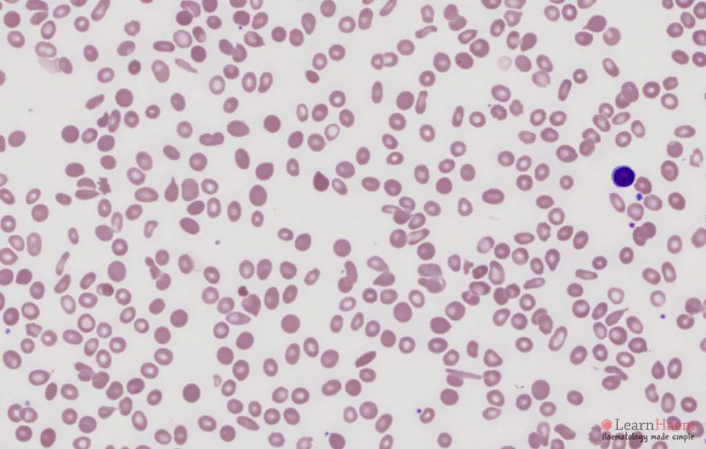 Anisopoikilocytosis. Peripheral blood film showing anisopoikilocytosis.