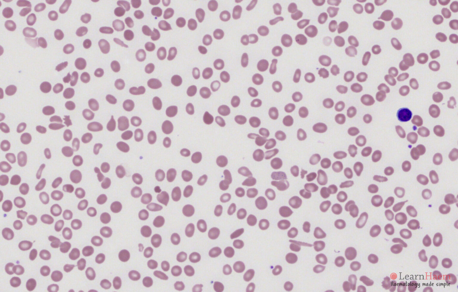 Anisopoikilocytosis - LearnHaem | Haematology Made Simple