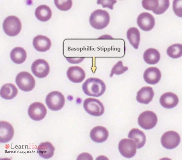 Basophilic Stippling LearnHaem Haematology Made Simple