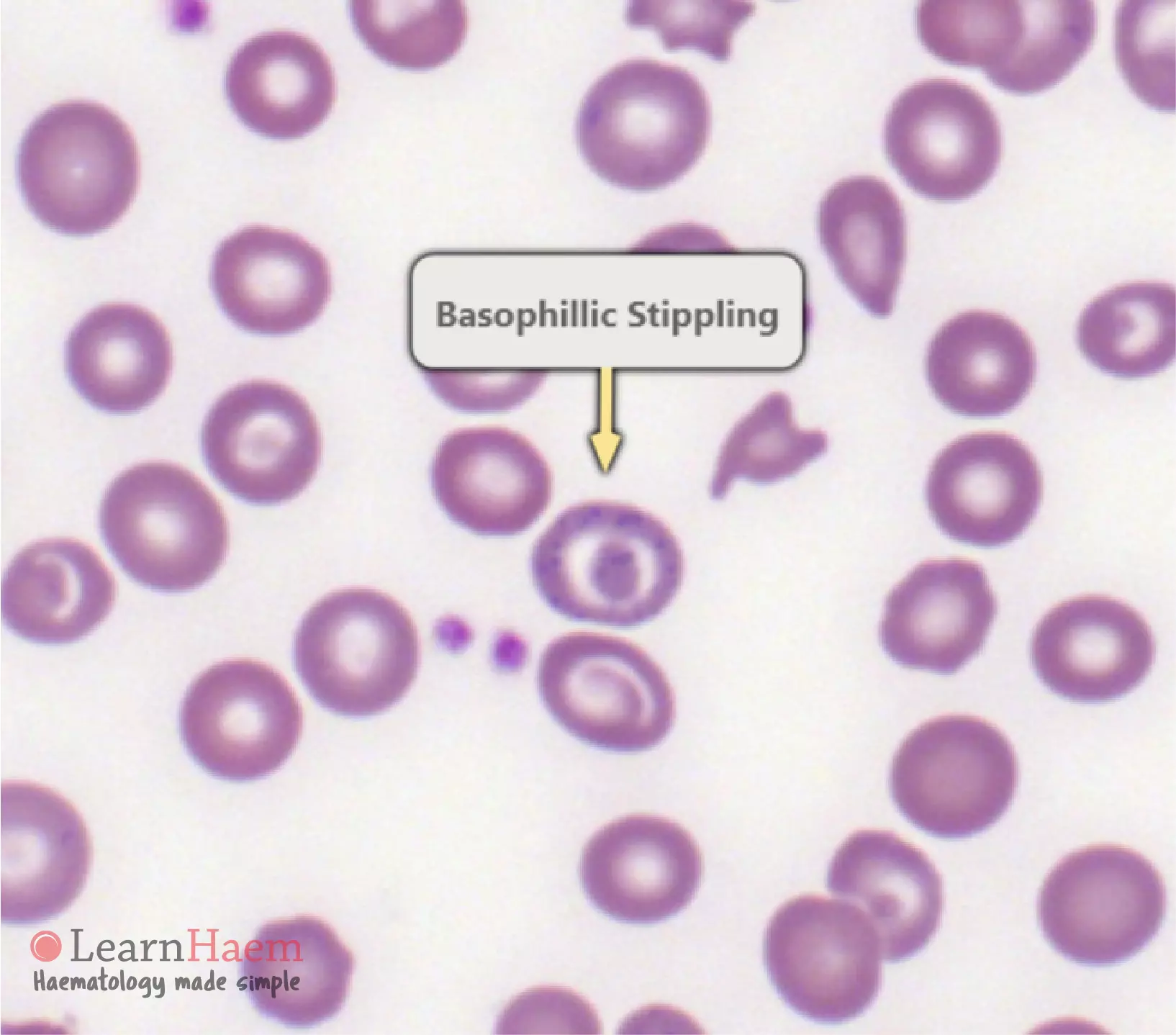 Basophilic Stippling LearnHaem Haematology Made Simple