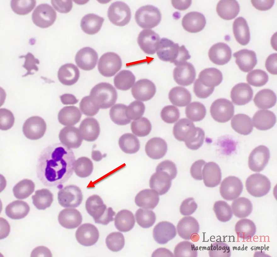 Basophilic Stippling. Peripheral blood film from a patient who had a splenectomy, showing basophilic stippling in two cells (red arrows).