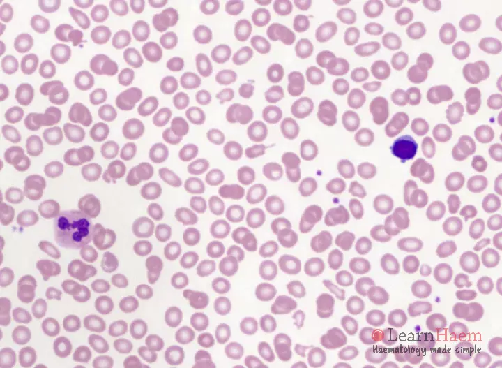 Microcytosis. Peripheral blood film showing microcytosis