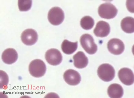 Bite Cells. Peripheral blood film from a patient with oxidative haemolysis showing bite cells.