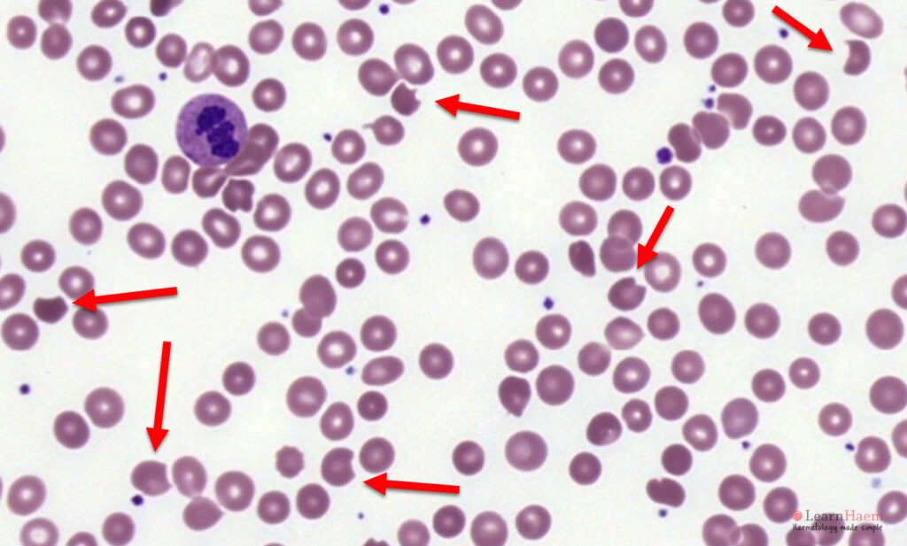 Bite cells. Peripheral blood film from a patient with oxidative haemolysis showing bite cells (red arrows).