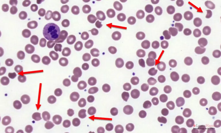 Krizocyte Rbc Bite Cells / Blister Cells - LearnHaem | Haematology Made Simple