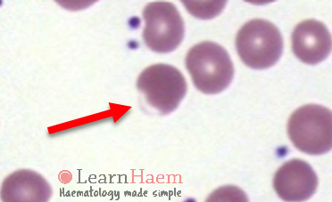 Blister cell. Peripheral blood film from a patient with oxidative haemolysis showing a blister cell. Note the thin rim of red cell membrane surrounding the blister (red arrow).