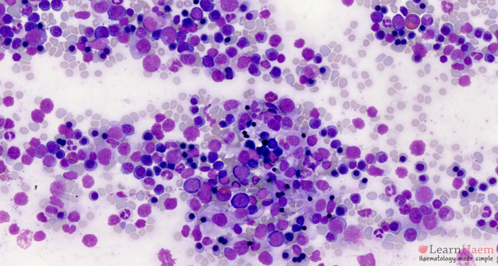 Congenital Dyserythropoietic Anaemia LearnHaem Haematology Made Simple