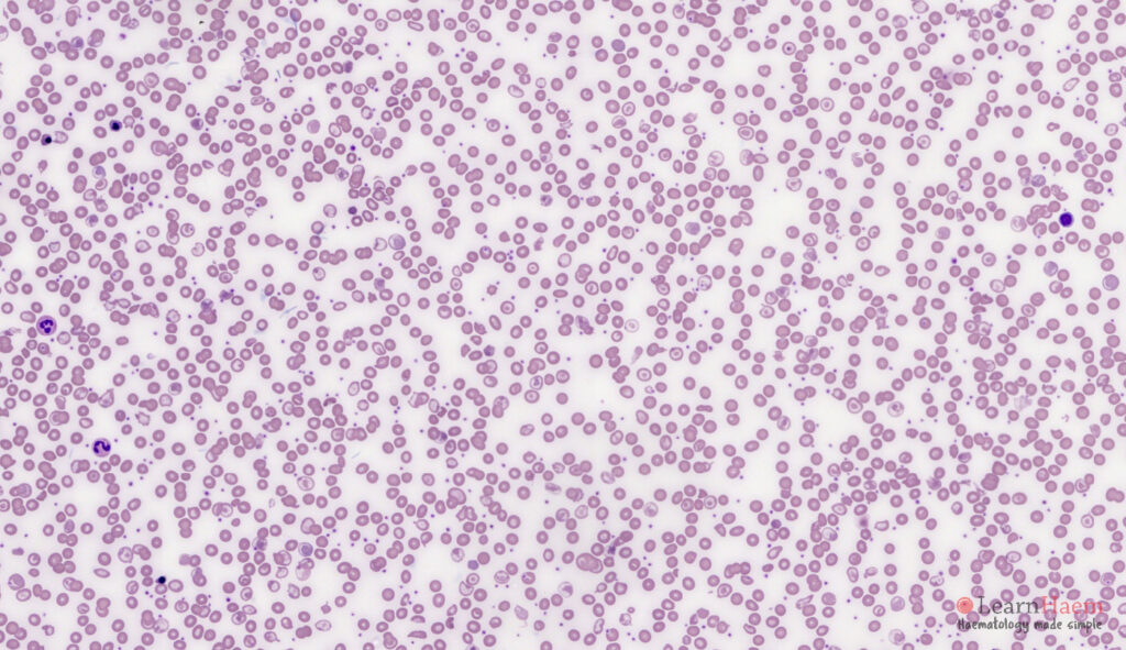 Dimorphic Picture. Peripheral blood film from a patient with haemoglobin E / ß thalassaemia compound heterozygosity, showing the native hypochromic, microcytic population with numerous target cells, and a transfused population with normochromic, normocytic red blood cells. The dimorphic appearance is often more apparent at lower magnification.