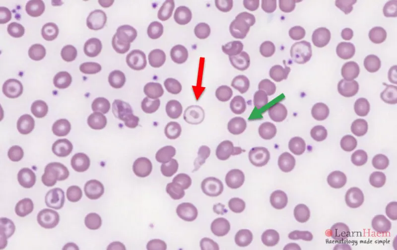 Dimorphic Picture LearnHaem Haematology Made Simple dimorphic-picture-learnhaem-haematology-made-simple