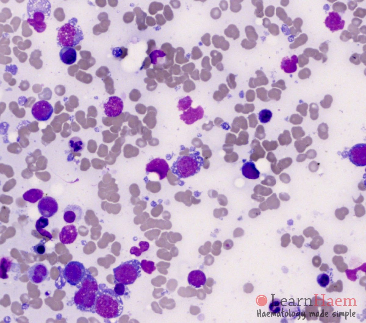 Diffuse Large B Cell Lymphoma LearnHaem Haematology Made Simple Diffuse Large B Cell Lymphoma LearnHaem Haematology Made Simple