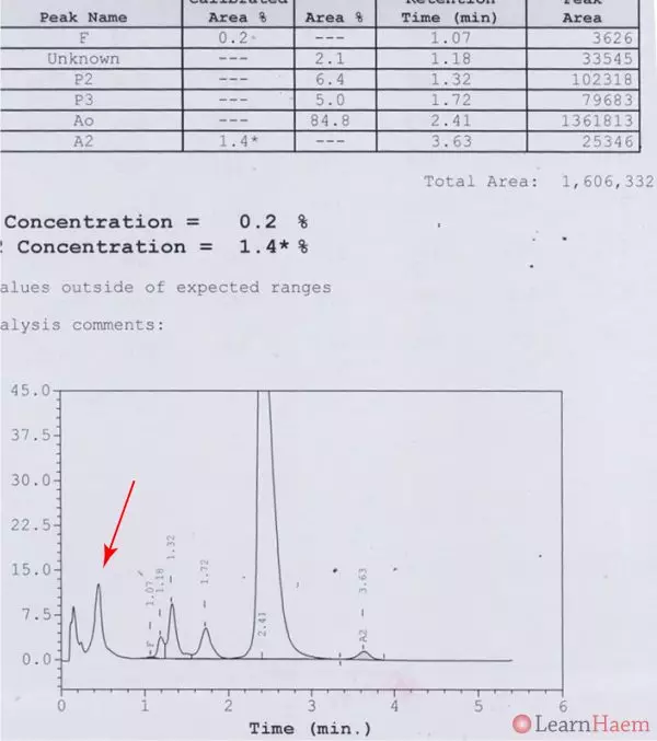Haemoglobin H (HbH) Disease LearnHaem Haematology Made Simple