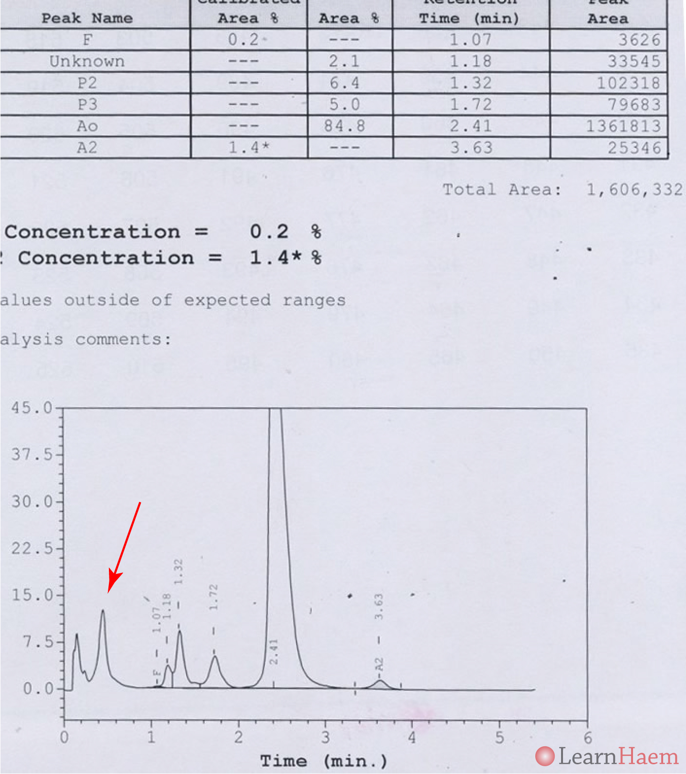 Haemoglobin H (HbH) Disease LearnHaem Haematology Made Simple