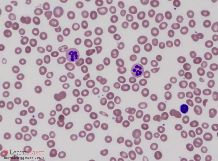 Megaloblastic Anemia Peripheral Smear