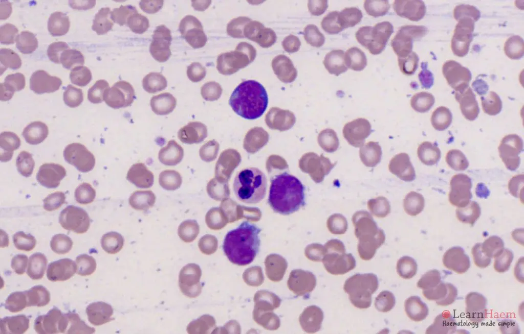 Mantle Cell Lymphoma Learnhaem Haematology Made Simple