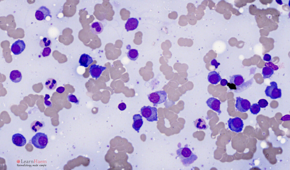 Multiple Myeloma LearnHaem Haematology Made Simple