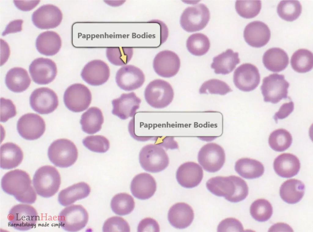 Pappenheimer Bodies. Peripheral blood film from a patient who had a splenectomy, showing fine peripheral aggregates in the red cells. These are Pappenheimer bodies, and are often easy to miss.