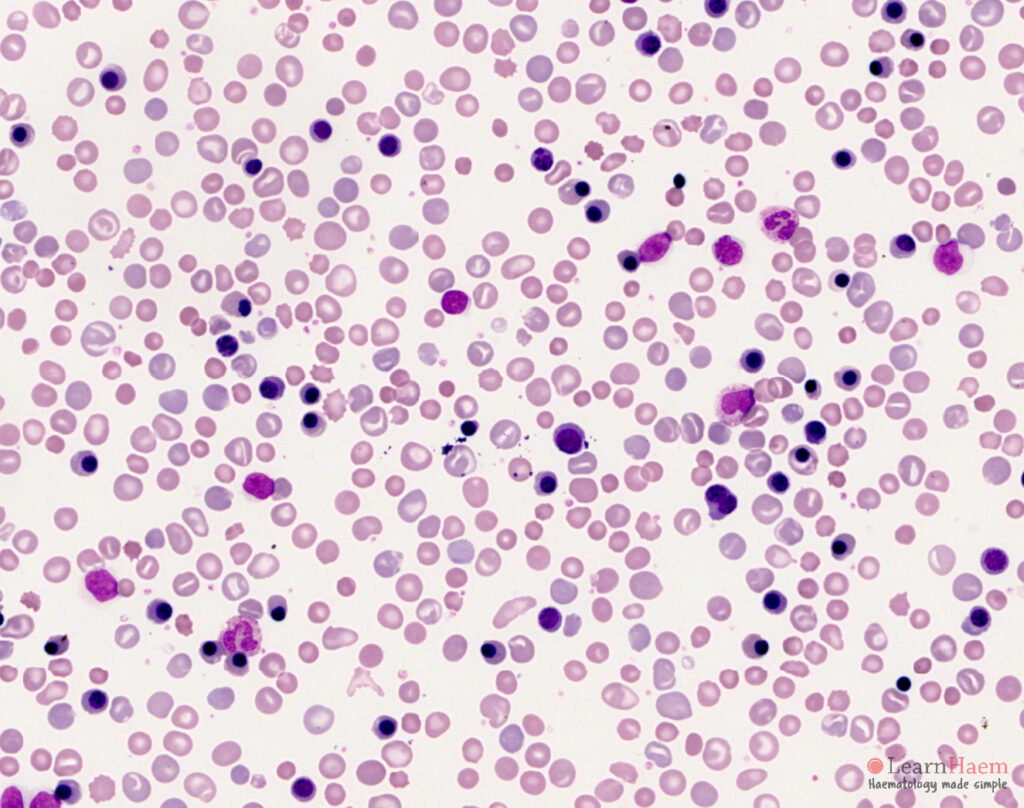 Polychromasia. Peripheral blood film from a neonate with haemolytic disease of the newborn, showing marked polychromasia, numerous circulating erythroblasts and spherocytes. Note the marked range in colours of the red cells and red cell precursors, with the cytoplasm ranging from a purplish colour to the normal pink cytoplasm of mature, haemoglobinised RBCs. Many polychromatic cells are larger than normal RBCs, as they are actually reticulocytes. The staining of the residual RNA is what gives the distinct purplish hue.