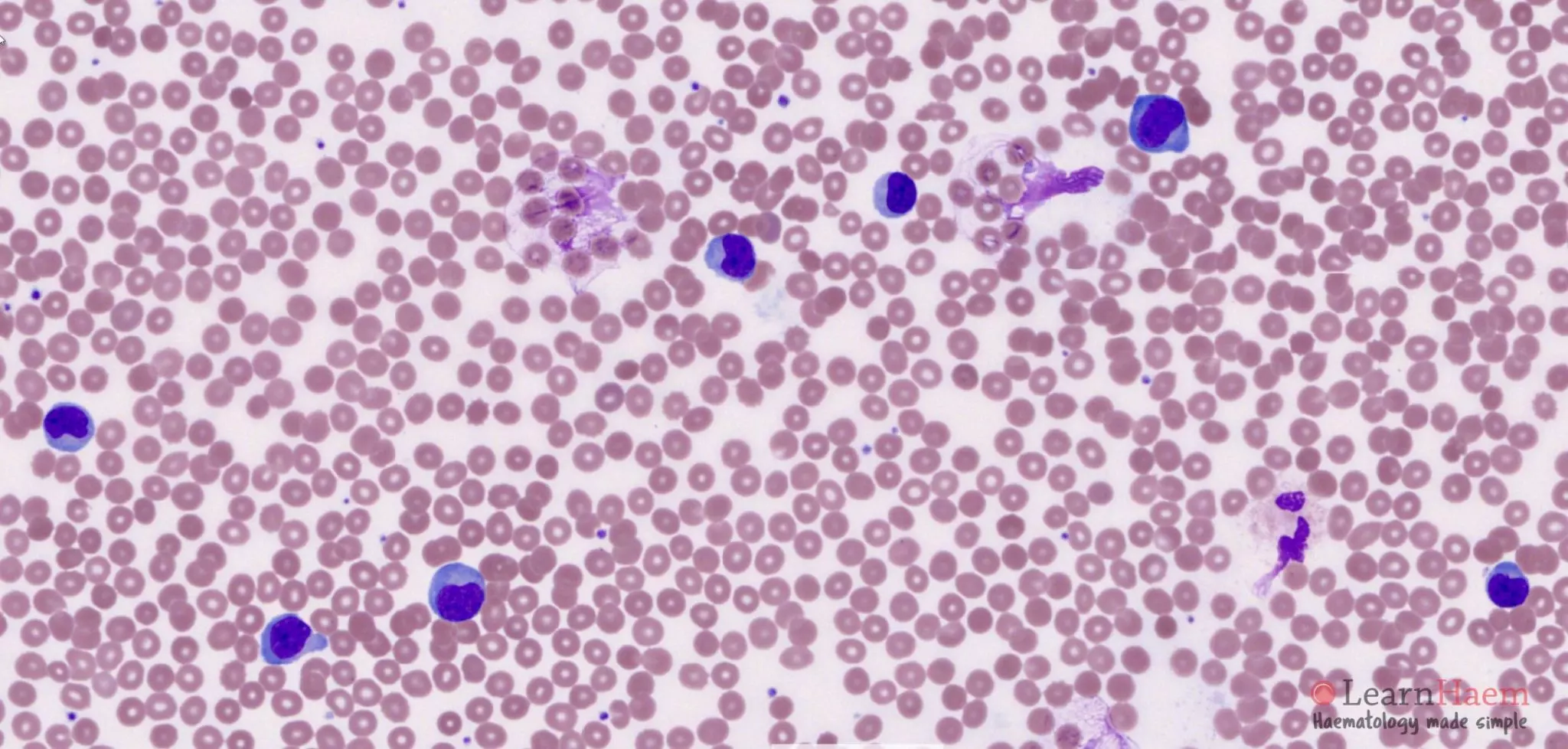 Reactive Lymphocytes Benign Disorders Learnhaem Haematology Made