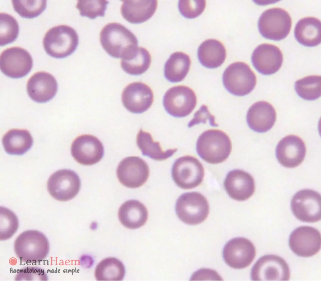 Schistocyte. Peripheral blood film from a patient with microangiopathic haemolytic anaemia, showing a schistocyte (fragmented red blood cell).