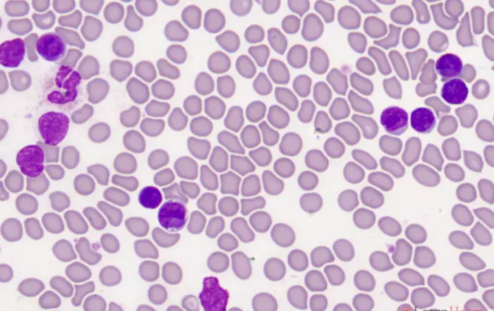 sezary cells