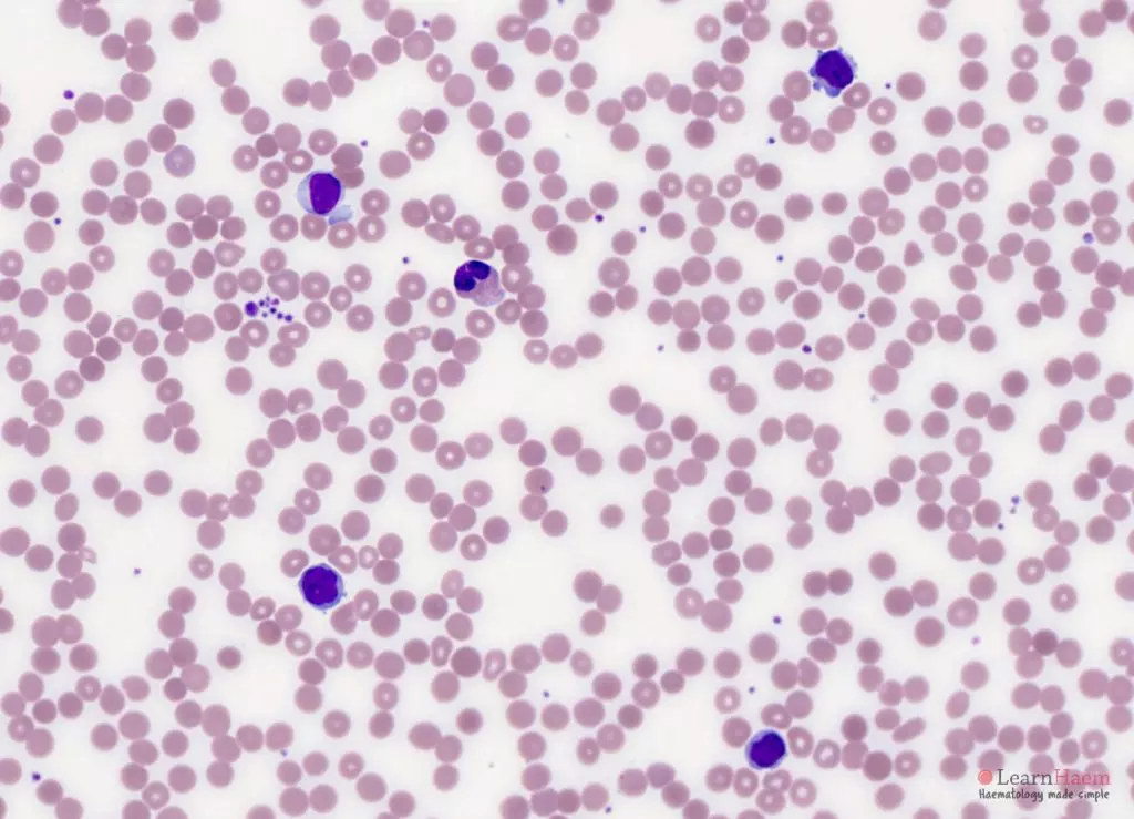 Marginal Zone Lymphoma Learnhaem Haematology Made Simple