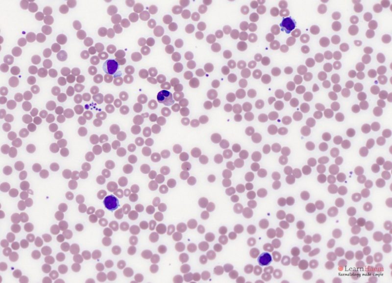 Smzl Marginal Zone Lymphoma - LearnHaem | Haematology Made Simple