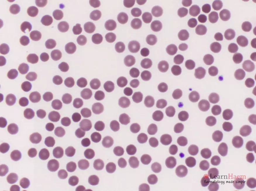 Spherocytes. Peripheral blood film from a patient with hereditary spherocytosis. Note the numerous dense, almost perfectly circular red cells which lack the characteristic central pallor.