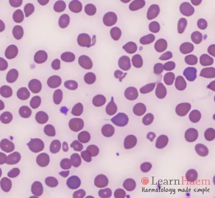 Teardrop Cell. Peripheral blood film from a patient with myelofibrosis, showing teardrop cells and polychromasia.