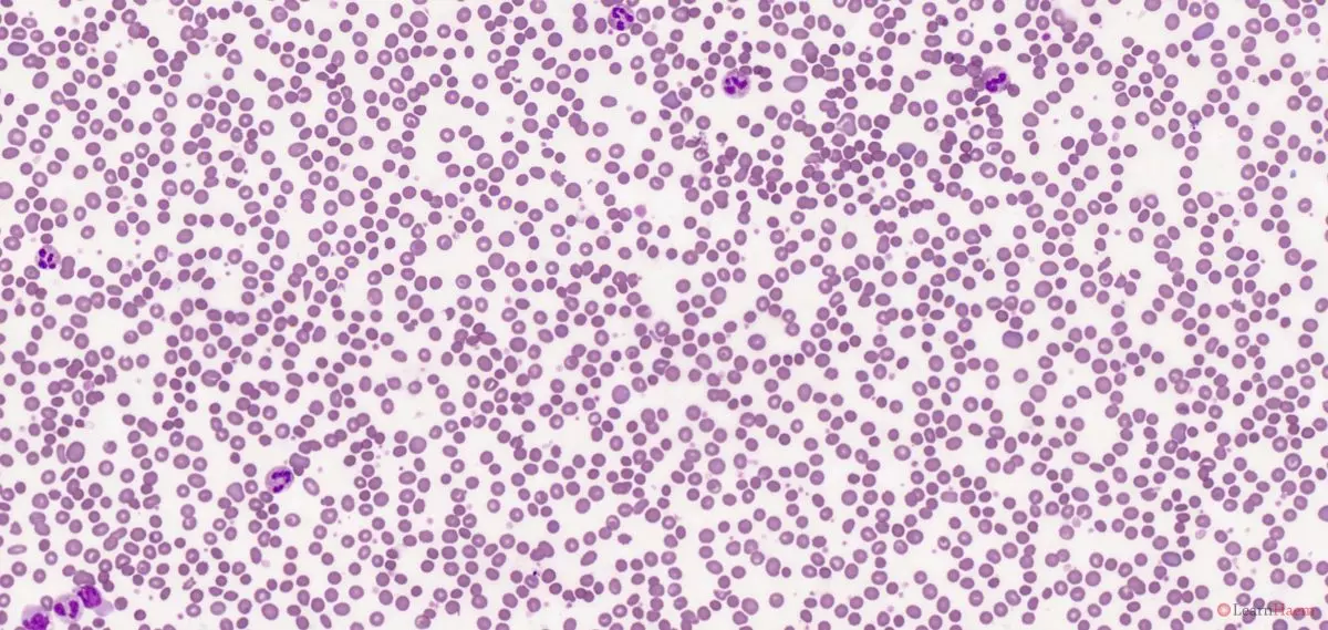 Autoimmune Haemolytic Anaemia - LearnHaem | Haematology Made Simple