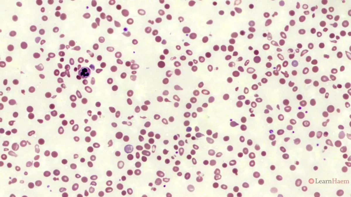 Beta Thalassaemia Hb E Compound Heterozygote LearnHaem beta-thalassaemia-hb-e-compound-heterozygote-learnhaem