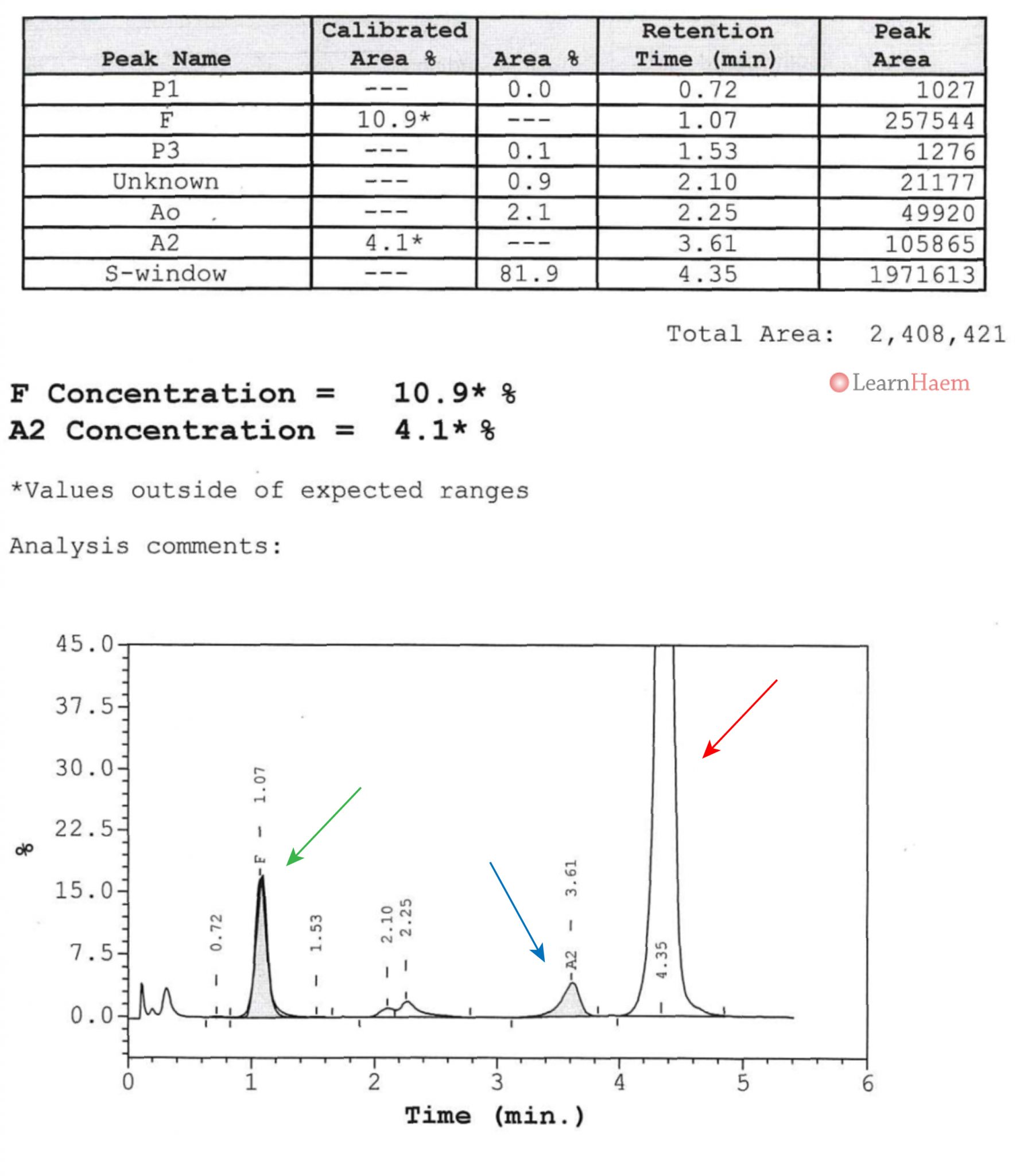 Sickle Cell Anaemia LearnHaem Haematology Made Simple