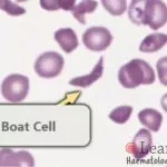 Boat cell seen in a patient with haemoglobin SC disease. These often have an appearance of a boat viewed from the top, and are seen in many sickling disorders.