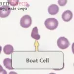 Boat cell seen in a patient with haemoglobin SC disease. These often have an appearance of a boat viewed from the top, and are seen in many sickling disorders.