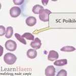 Peripheral blood film from a patient with haemoglobin SC disease showing an SC poikilocyte. These cells which have a variable appearance but are usually dense and may resemble sickle cells. They often have single or multiple angulated branches; some which resemble sickle cells may instead have straight edges. Classical SC poikilocytes may be quite rare, so they must be actively sought.