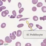 Peripheral blood film from a patient with haemoglobin SC disease showing an SC poikilocyte. These cells which have a variable appearance but are usually dense and may resemble sickle cells. They often have single or multiple angulated branches; some which resemble sickle cells may instead have straight edges. Classical SC poikilocytes may be quite rare, so they must be actively sought.