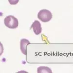 Peripheral blood film from a patient with haemoglobin SC disease showing an SC poikilocyte. These cells which have a variable appearance but are usually dense and may resemble sickle cells. They often have single or multiple angulated branches; some which resemble sickle cells may instead have straight edges. Classical SC poikilocytes may be quite rare, so they must be actively sought.