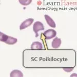 Peripheral blood film from a patient with haemoglobin SC disease showing an SC poikilocyte. These cells which have a variable appearance but are usually dense and may resemble sickle cells. They often have single or multiple angulated branches; some which resemble sickle cells may instead have straight edges. Classical SC poikilocytes may be quite rare, so they must be actively sought.