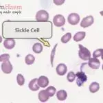 Peripheral blood film from a patient with haemoglobin SC disease showing a sickle cell.