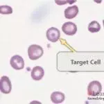 Peripheral blood film from a patient with haemoglobin SC disease showing a target cell.