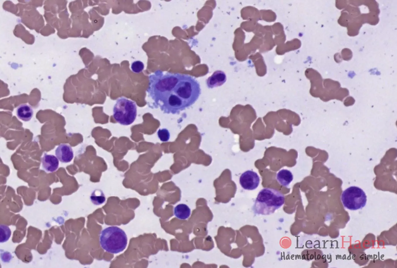 Haemophagocytic Lymphohistiocytosis - LearnHaem | Haematology Made Simple